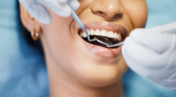 Best Knocked-Out Tooth (Avulsed Tooth) Treatment in Heidelberg, PA