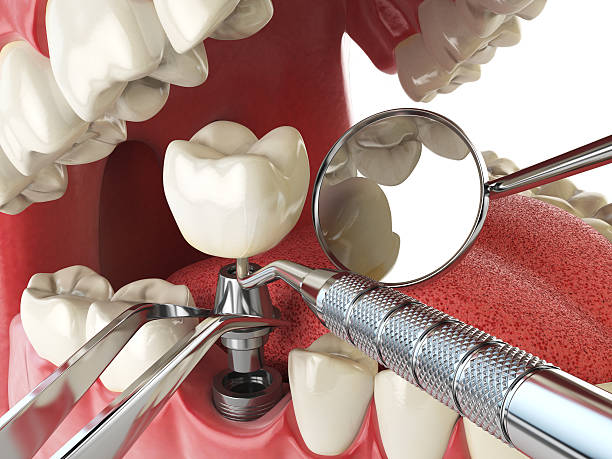 Best Emergency Root Canal Therapy in Heidelberg, PA